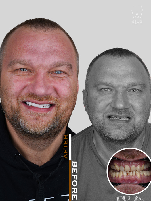 Before after case