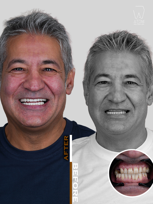 Before after case